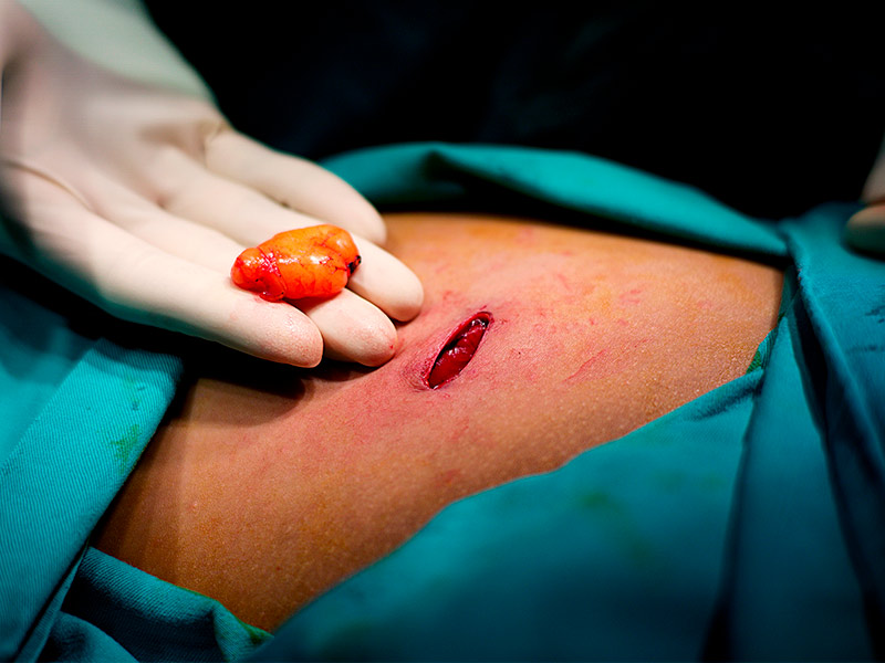 Mão com luva segurando o nódulo de gordura após a cirurgia de lipoma