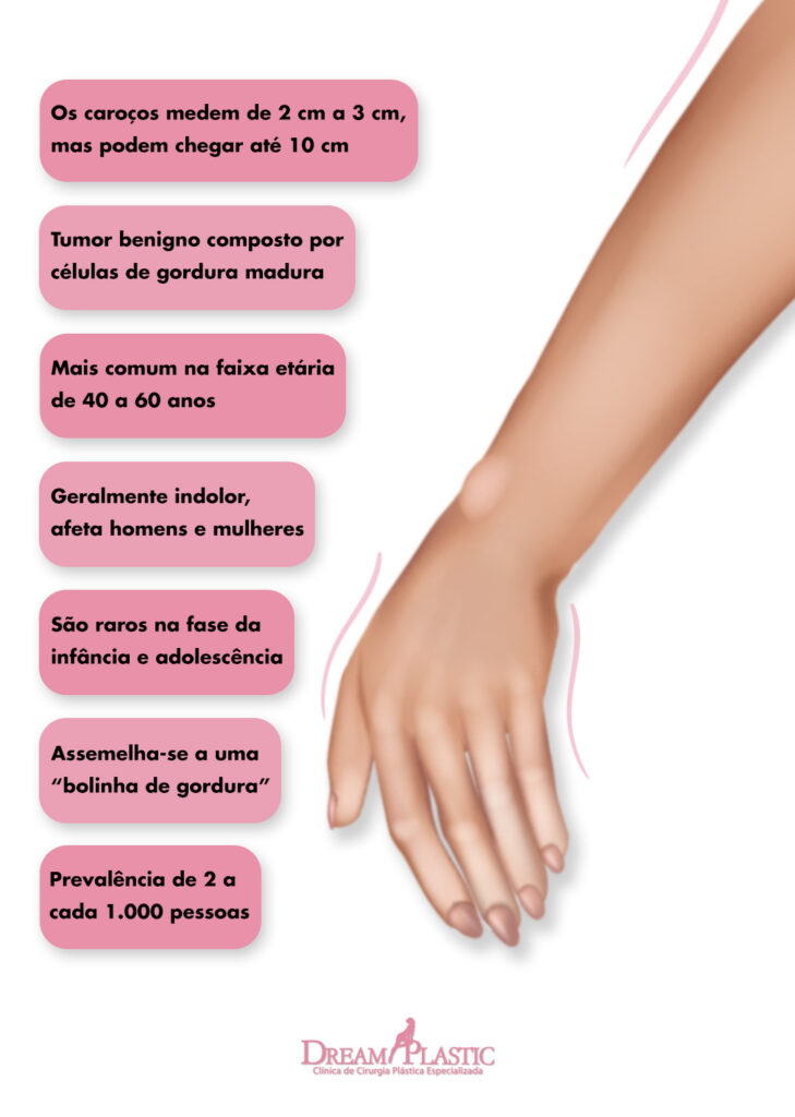 Principais dados sobre os lipomas infográfico com o resumo sobre o lipoma, do lado de um braço com um tumor de gordura