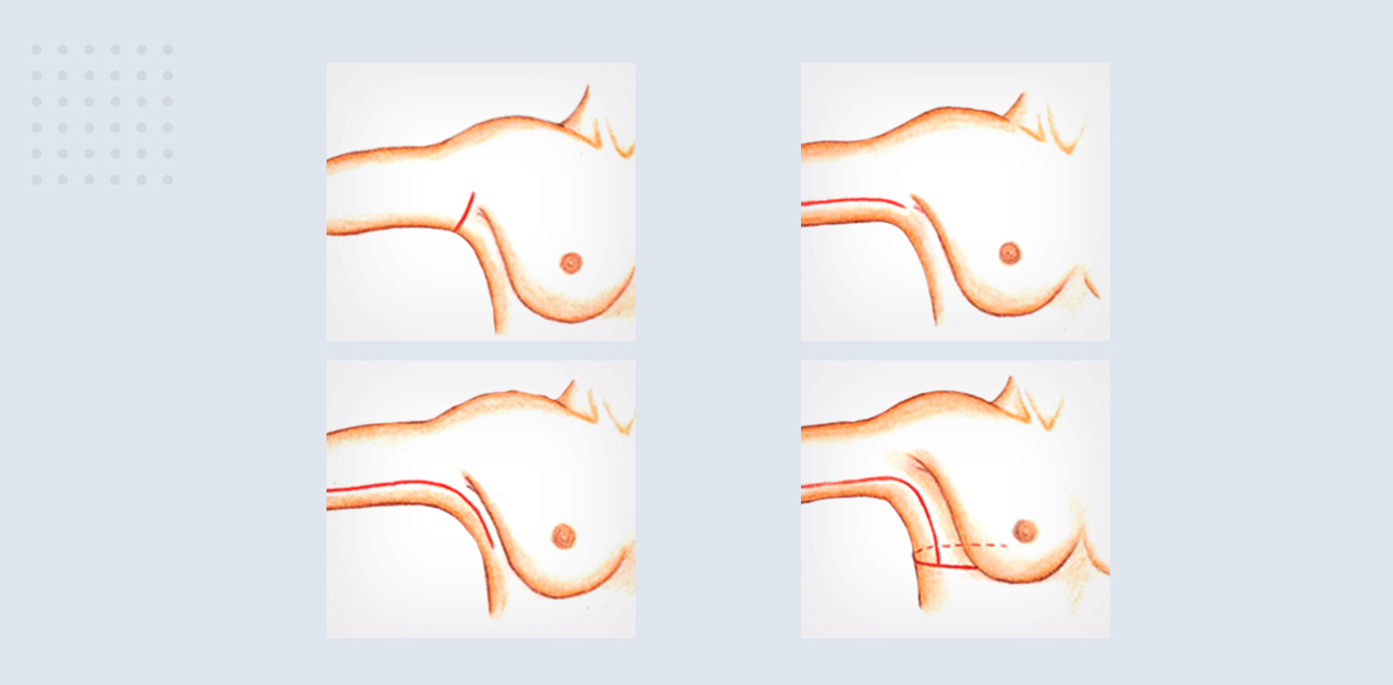 Ilustração que mostra os 4 tipos de incisão da braquioplastia