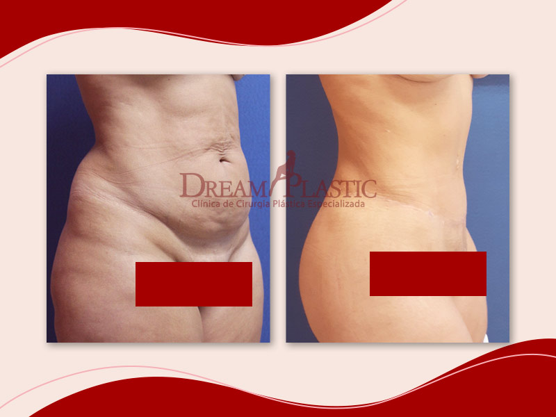 Imagem de uma paciente da Dream Plastic antes e depois da Abdominoplastia Clássica