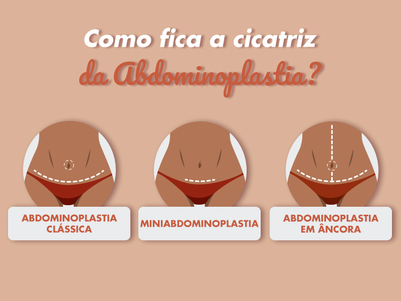 Como fica a cicatriz da cirurgia para tirar estrias? cicatriz procedimento estrias