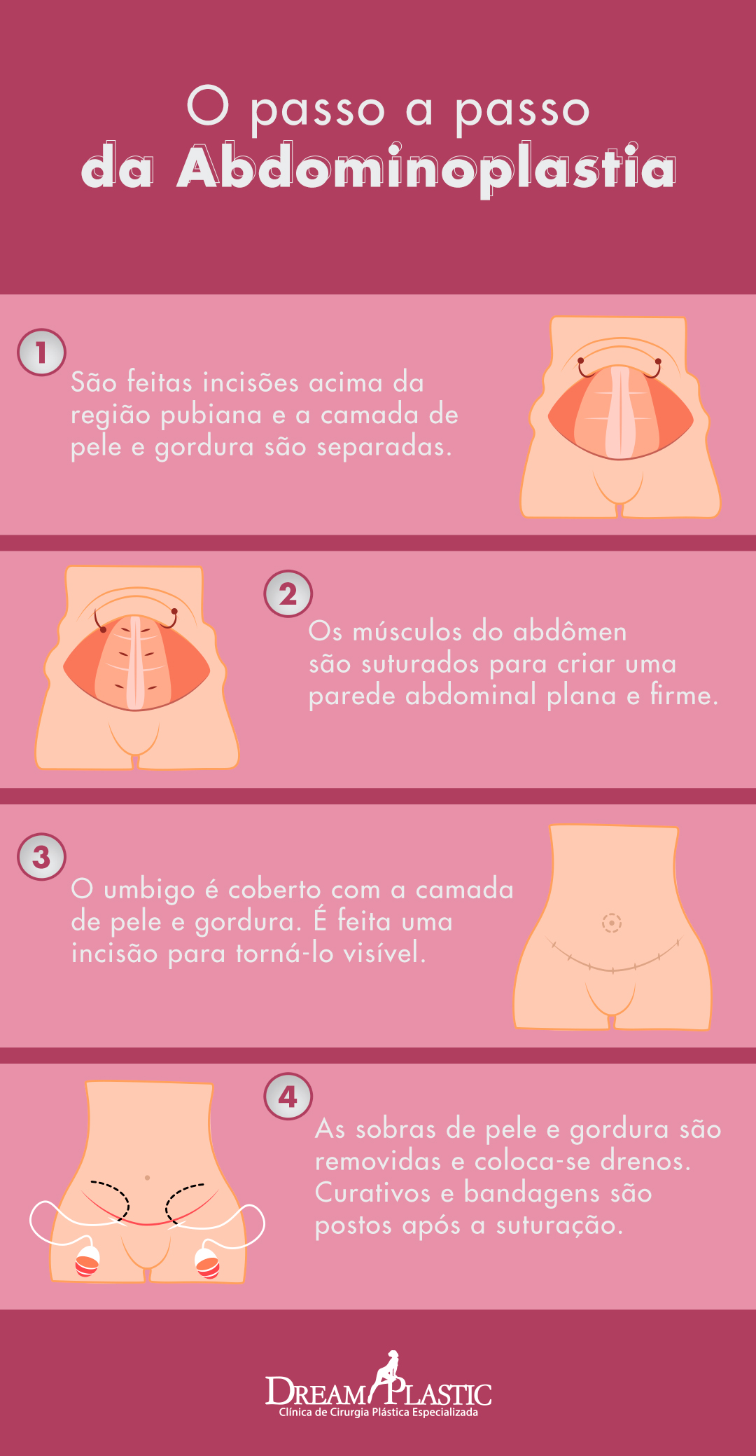 infográfico com o passo a passo da abdominoplastia