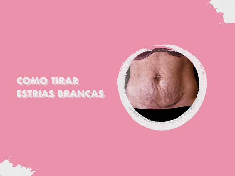 Como tirar estrias? Conheça a solução definitiva para esse problema e dê adeus às estrias brancas em 2021! como tirar estrias brancas