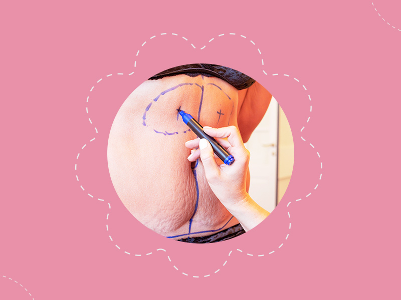 mulher fazendo marcação de abdominoplastia cirurgia tirar estrias