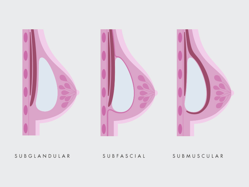 Prótese de Silicone por cima ou por baixo do músculo? ilustração com a localidade da prótese de silicone