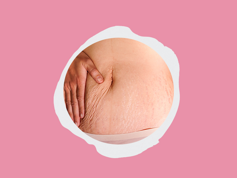 Mulher apertando a barriga para mostrar as estrias na barriga na gravidez
