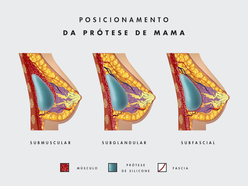 ilustração de uma mama mostrando o posicionamento da prótese mama