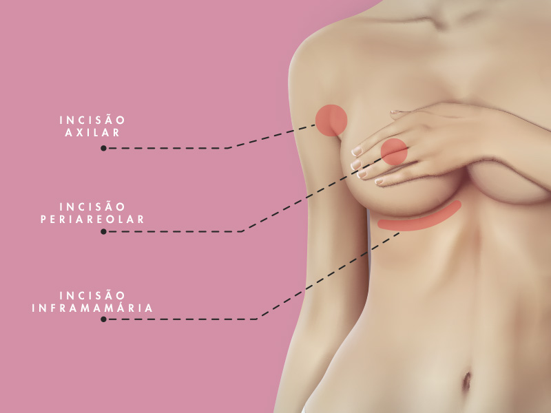 ilustração com os locais de incisão da prótese de mama