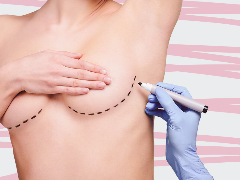 médico fazendo marcação da prótese mama