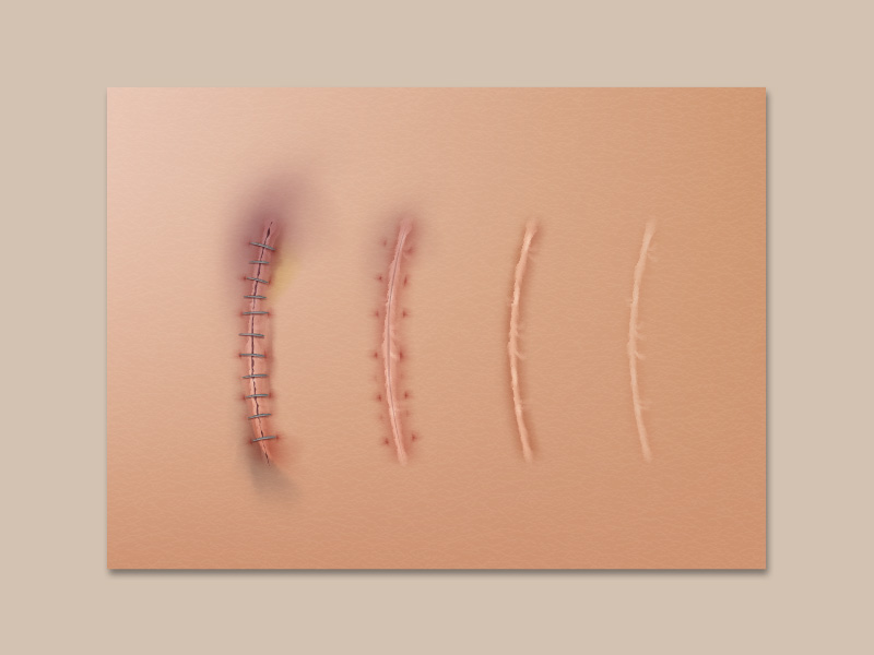 ilustração mostrando a recuperação da cicatriz da prótese mama 
