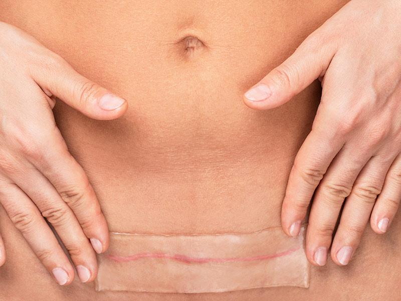 Mulher com adesivo de silicone na cicatriz de abdominoplastia