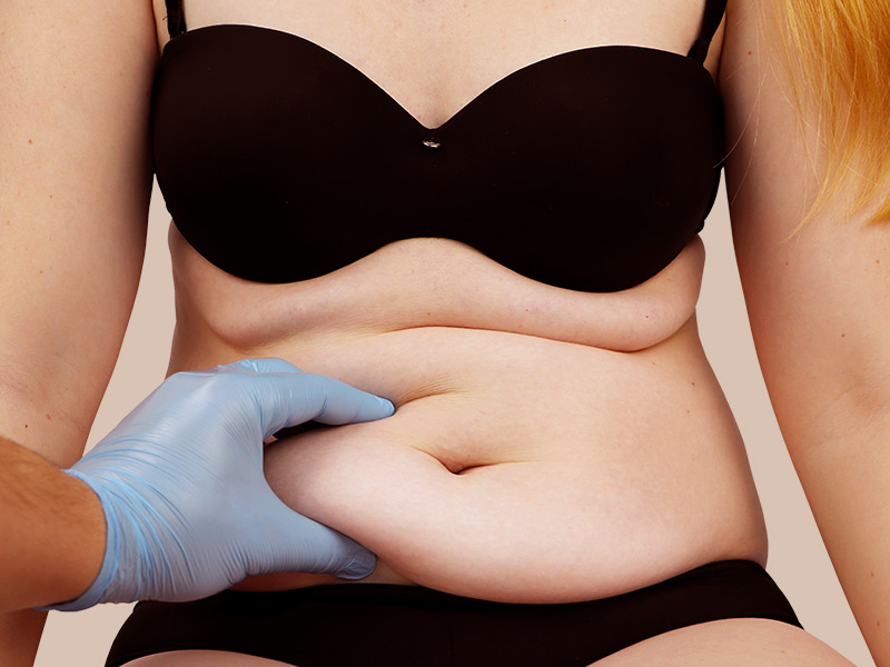 mulher mostrando barriga flácida pensando em uma Abdominoplastia sem Lipoaspiracao