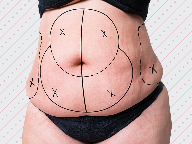 Médico faz linhas de demarcação para a cirurgia na barriga mulher com as marcações da cirurgia de abdominoplastia