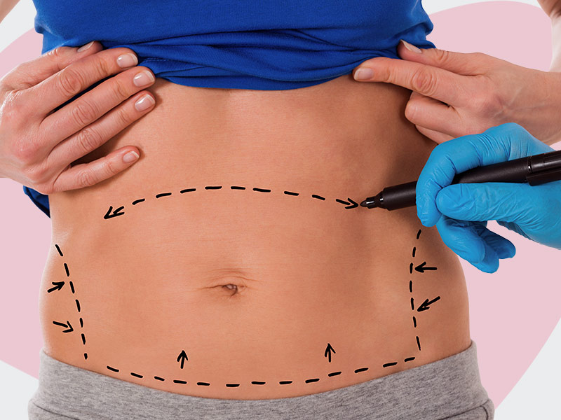 marcação da Abdominoplastia com Lipoaspiracao