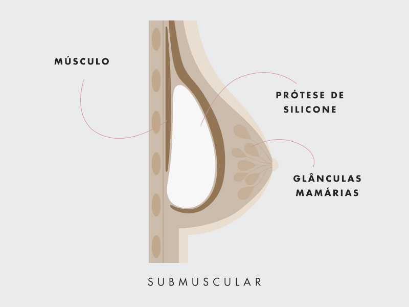 ilustração com a anatomia da mama com silicone abaixo do músculo