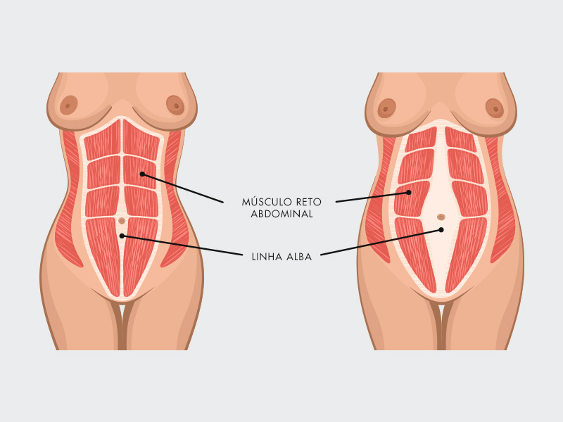 ilustração de uma mulher com e sem diástase