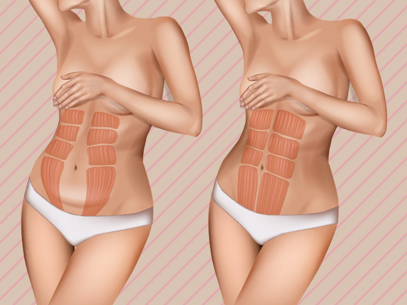uma barriga com diástase abdominal ilustração para corrigir diástase abdominal