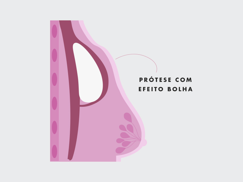Efeito dupla bolha dupla bolha silicone