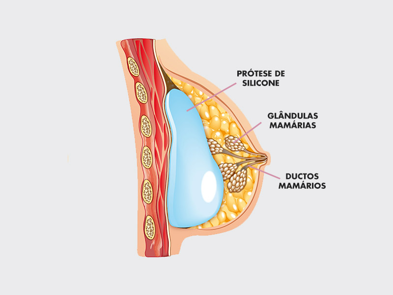 ilustração da anatomia mama amamentação silicone 