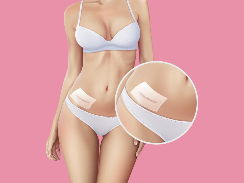 Ilustração de mulher com placa de silicone para queloide na cicatriz de lipoaspiração