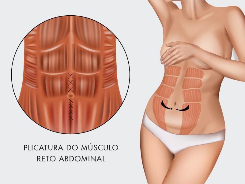 ilustração mostrando a plicatura na abdominoplastia 