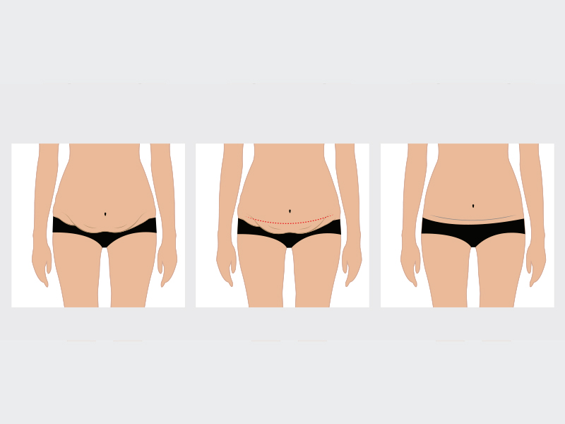ilustração mostrando como é feita a mini abdominoplastia 