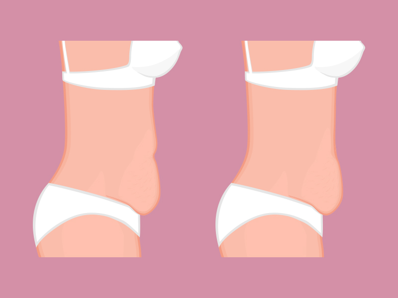 De um lado há a ilustração de uma abdominoplastia clássica, do outro de uma mini abdominoplastia