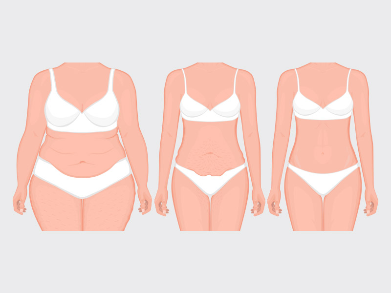 ilustração mostrando o antes e depois de uma paciente de abdominoplastia em âncora