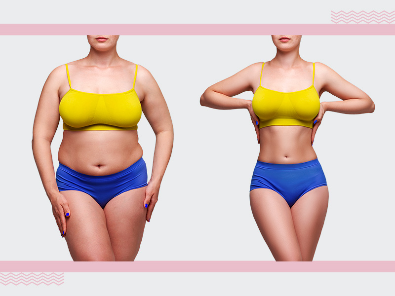 Abdominoplastia e Lipo - Saiba tudo sobre as cirurgias combinadas