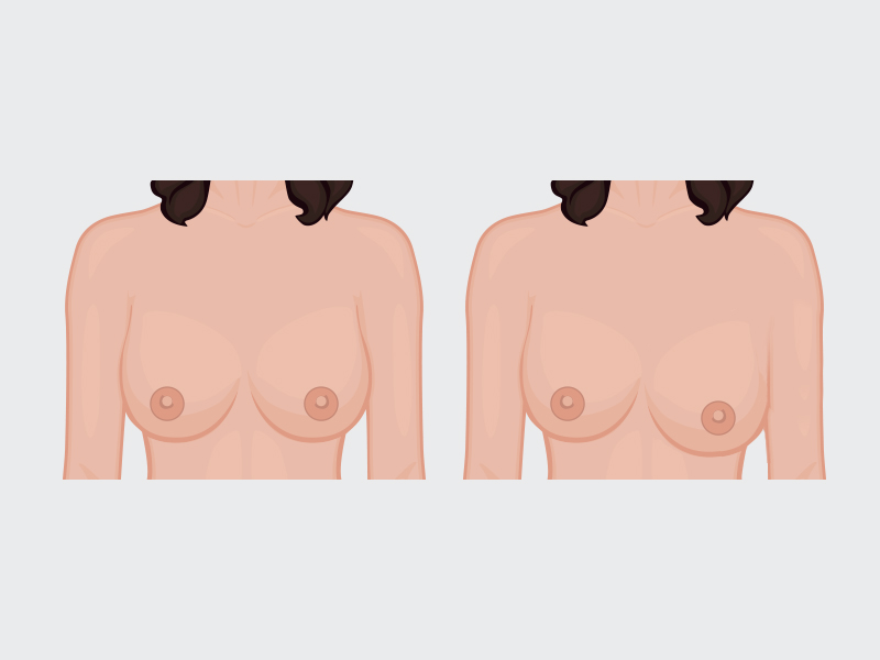 Deslocamento da prótese de silicone deslocamento da protese