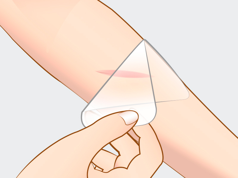 Ilustração de dedos puxando a fita pós cirúrgica de silicone do braço