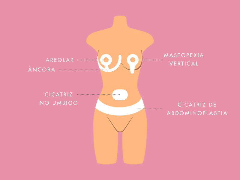 Ilustração que mostra os formatos das tiras de silicone para cicatriz em diferentes partes do corpo