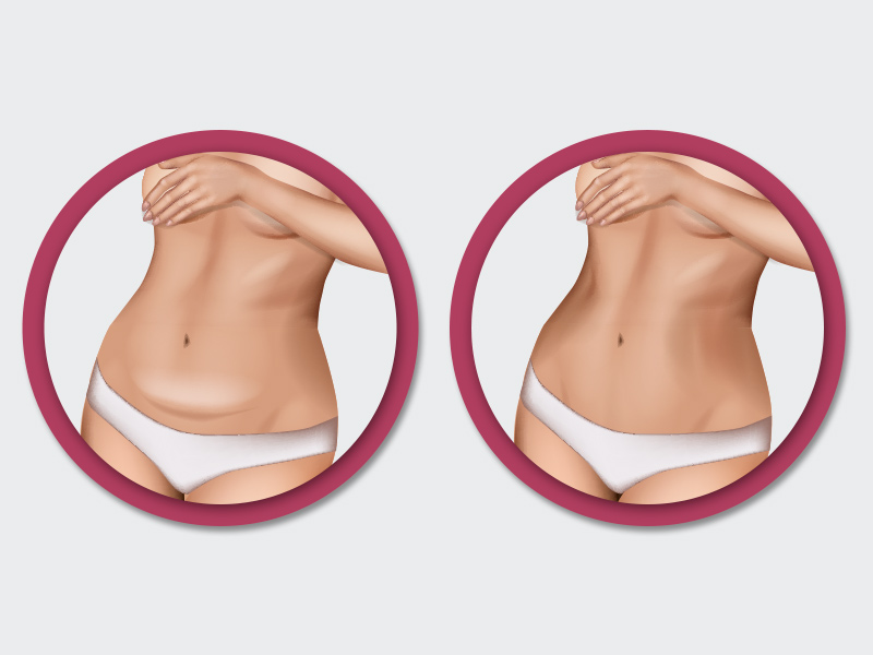 ilustração da diferença entre uma barriga normal e uma com estômago alto