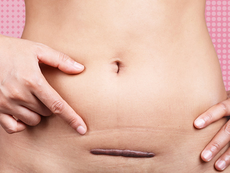 mulher com queloide na cicatriz da abdominoplastia, uma complicação da cirurgia