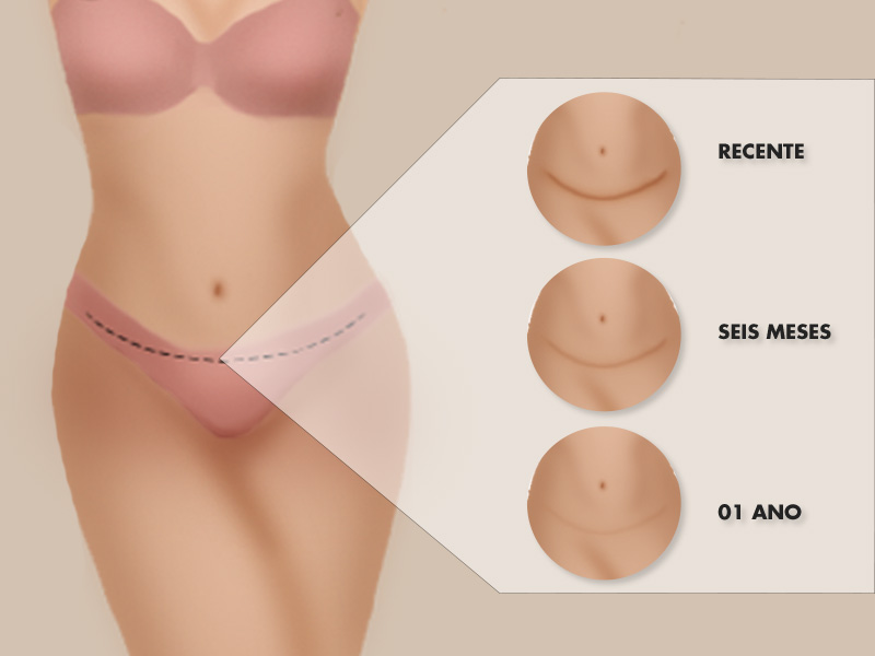 ilustração mostrando a evolução da cicatriz abdominoplastia