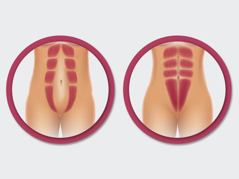 ilustração mostrando o antes e depois da diástase estomago alto