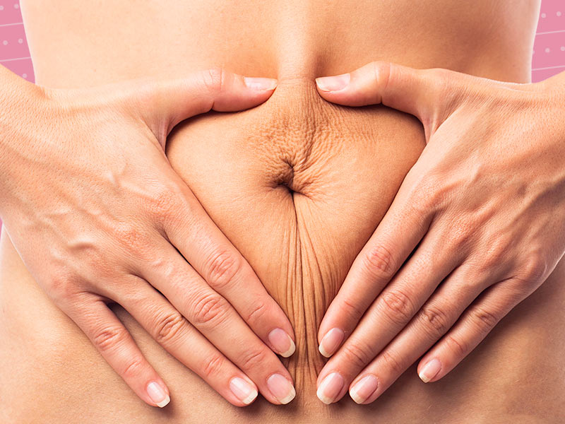 mulher com abdominoplastia com risco de umbigo fechado