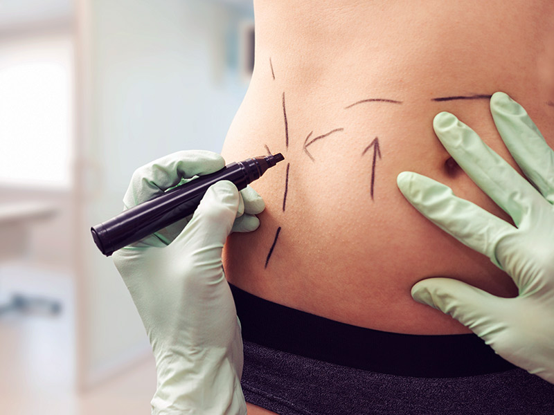 Quanto tempo dura a lipoescultura? tirar gordura barriga colocar gluteo