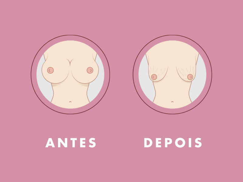 ilustração mostrando retirada silicone antes depois