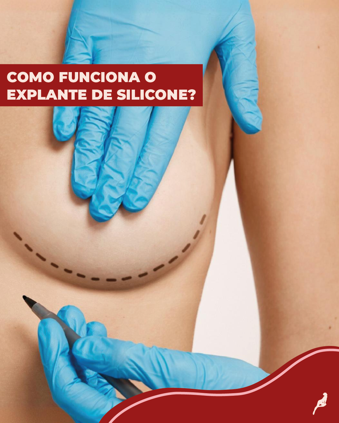 O que é explante de silicone? Seios com a marcação de caneta para fazer o explante de silicone