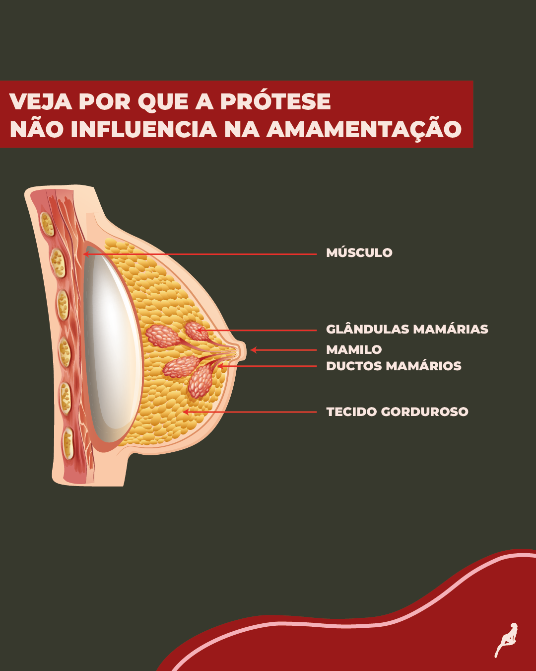 Ilustração que mostra o por que a prótese não influencia na amamentação, a prótese fica atrás de toda a estrutura responsável pela produção do leite. 