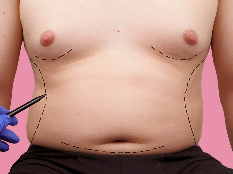 cirurgião plástico fazendo marcação da abdominoplastia na barriga de um homem com flacidez