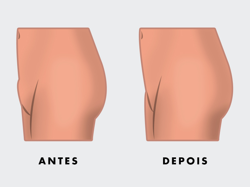 Ilustração mostrando o antes e depois da lipo da púbis