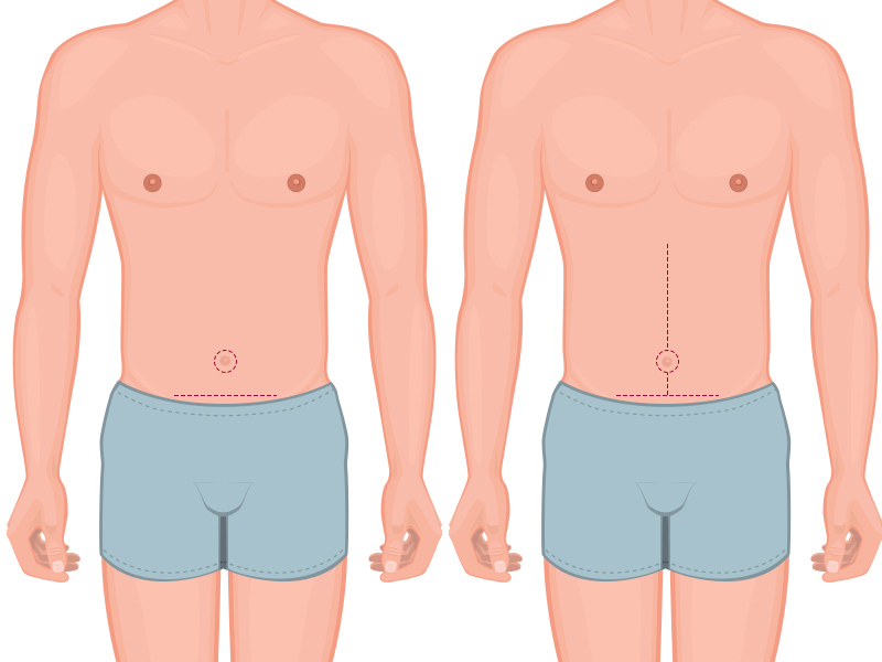 abdominoplastia masculina cicatriz