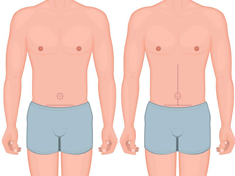 ilustração mostrando a cicatriz da abdominoplastia masculina