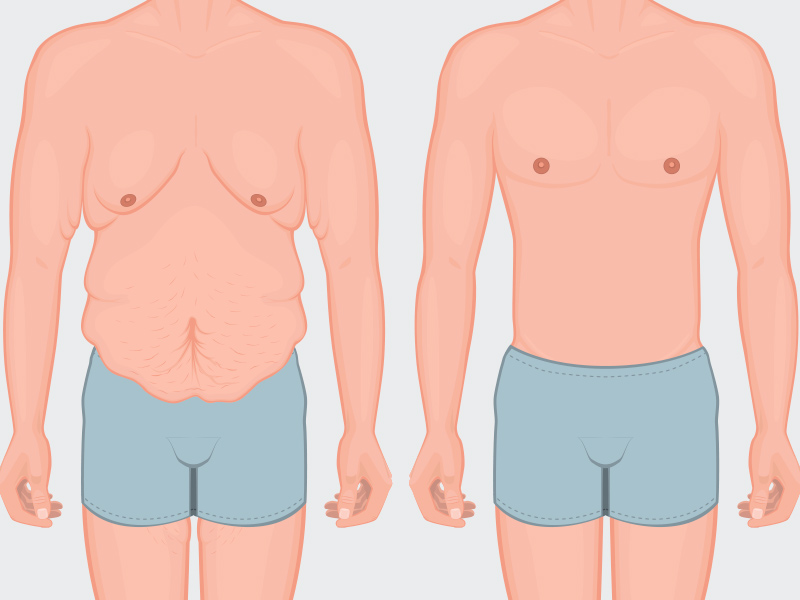 ilustração mostrando o antes e depois da cirurgia de abdominoplastia em homens