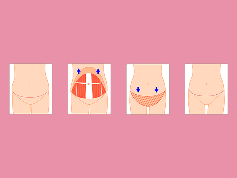 ilustração do passo a passo da abdominoplastia para homens, onde mostra a incisão, a retirada da pele e o fechamento da cicatriz