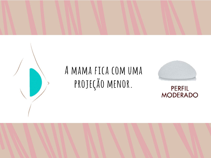 Como é a Prótese de Silicone perfil moderado? Ilustração mostrando a prótese de silicone perfil moderado dentro do seio
