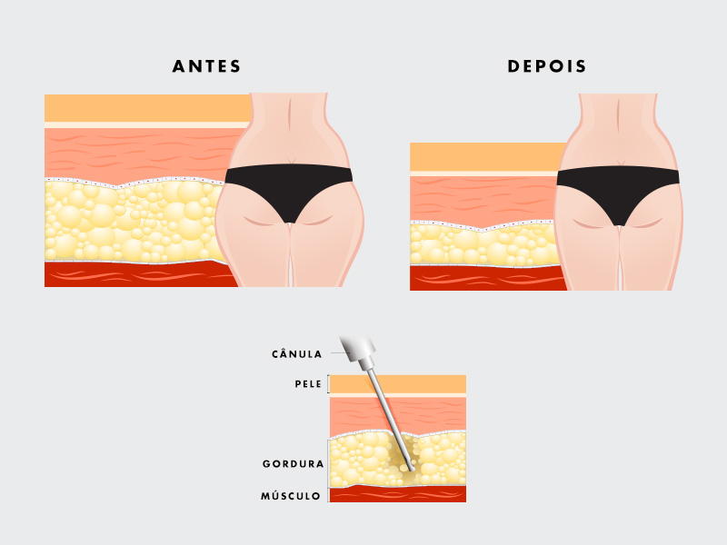 ilustração com o antes e depois da cirurgia para tirar culotes