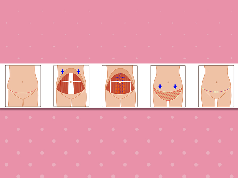 ilustração mostrando abdominoplastia e mamoplastia passo a passo 